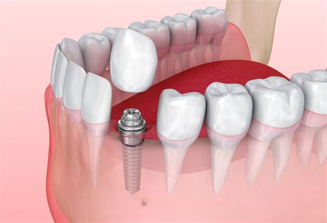 Implant-Supported Crowns – Nashville, TN – Iroquois Family Dentistry