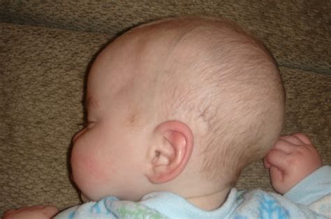 Normal or problem head shape? | BabyCenter