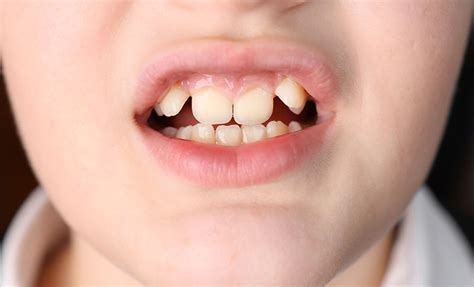 What Shark Teeth Means for a Child's Oral Health | Kenmore, WA | Kenmore Pediatric Dentistry