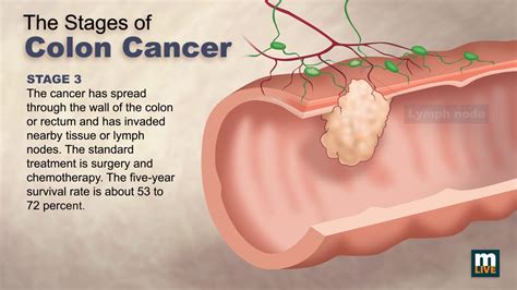 Stages of Colon Cancer - YouTube