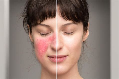 Premium Photo | Signs and symptoms of rosacea natural cures in the ...