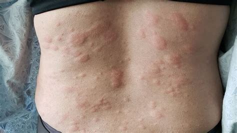 Is Liver Disease Causes Itchy Skin Danger? - Diag