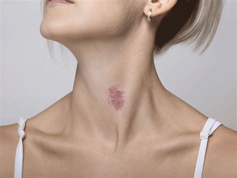 How To Remove Kiss Mark On Neck Quickly - Howto Techno