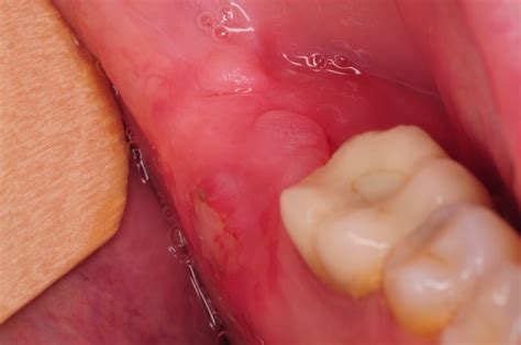 How Long Should My Mouth Hurt After Wisdom Teeth Removal - Infoupdate.org