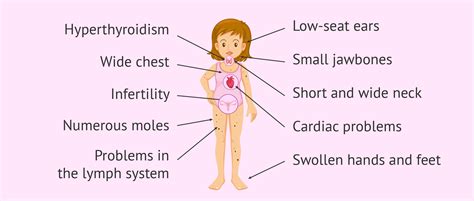 What is Turner syndrome? Its causes, characteristics and pregnancy