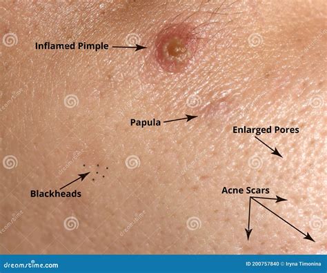 Types Of Acne And Acne On The Skin. Enlarged Pores, Inflamed Pimple, Blackheads, Acne Scars ...