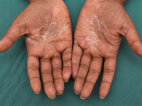 Hand Eczema | About and Treatments | Eczema.org