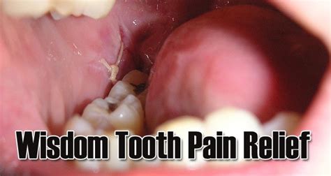 Home Remedies To Get Wisdom Teeth Pain Relief - Yabibo