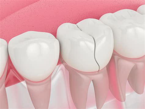 Can I Ignore a Cracked Tooth if it Doesn't Hurt? | Dr. Bill Dorfman, DDS - Century City ...