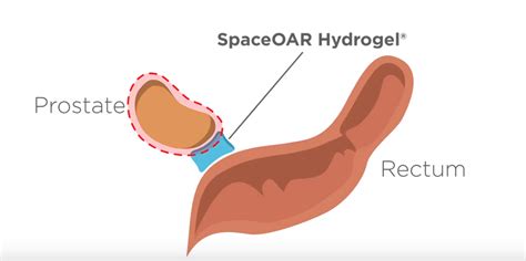 The SpaceOAR™ Procedure