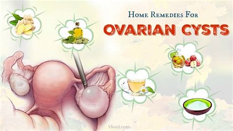 Top 15 Natural Home Remedies For Ovarian Cysts