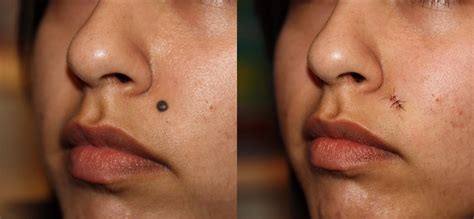 Mole Removal Prices, Costs | Skin Surgery Laser Clinic