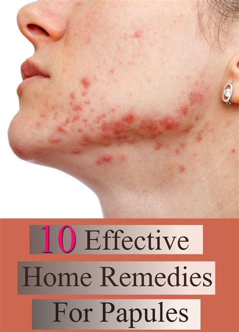 10 Effective Home Remedies For Papules | Search Home Remedy