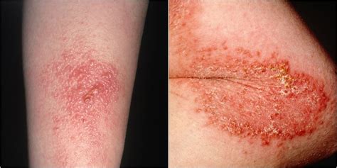 How to Get Rid of Poison Ivy Rash - Best Poison Ivy Remedies