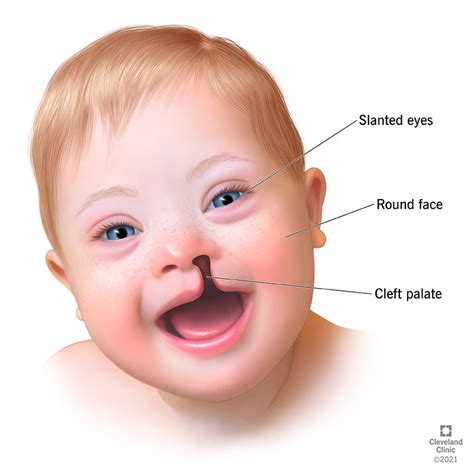 Trisomy: Types of Trisomy Disorders