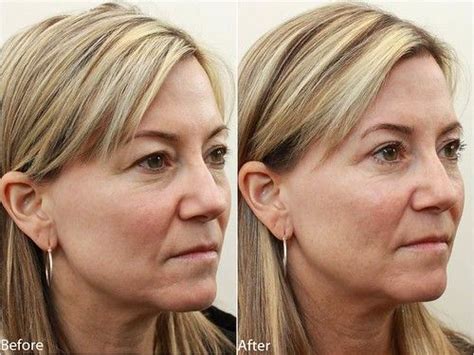 Dr. Darm, Eyelids Before and After - T.C. Slide2 | Dr. Jerry Darm | Flickr Hooded Eye Makeup ...