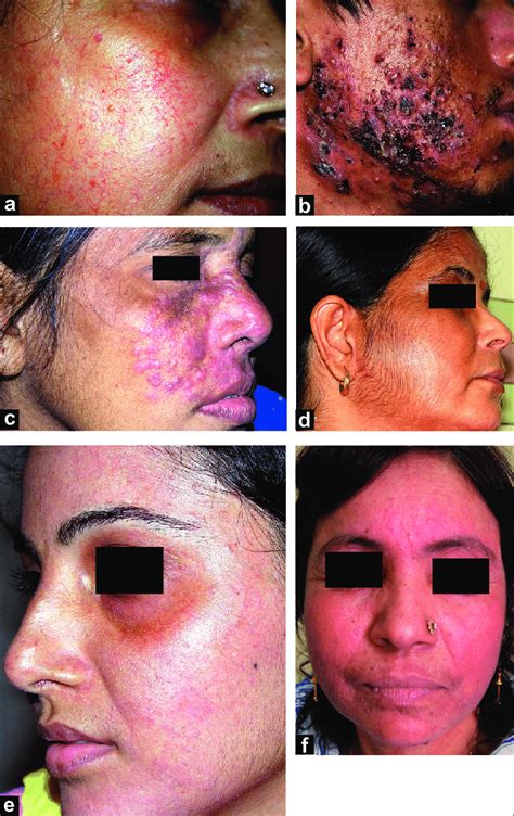 Adverse effects of topical corticosteroids on the face. (a) Marked... | Download Scientific Diagram