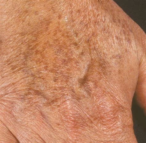 Liver Spots: Causes, Treatments, and Removal Options - YouMeMindBody