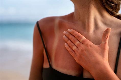 Sun Poisoning: Symptoms, treatment, and how to prevent