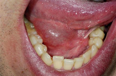 Salivary Gland Swelling