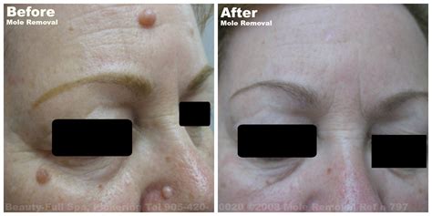 Mole Removal Before & After | Beauty-Full Spa