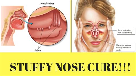 how to get rid of a blocked nose in 5 minutes - YouTube