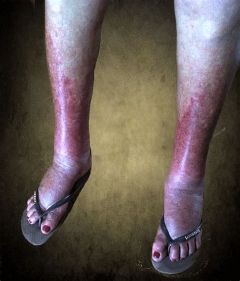 Cutaneous purpuric rash and edema of the ankles and feet (case courtesy... | Download Scientific ...