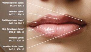 Lip Cancer: Not Uncommon, Often Overlooked - ChopSaver