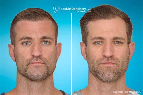 The Misaligned Jaw: Symptoms and Treatment