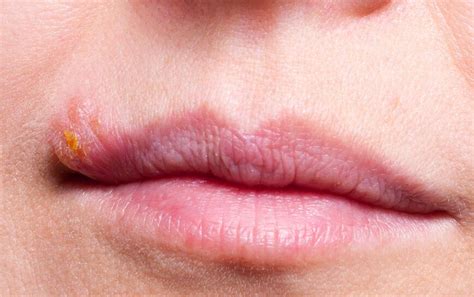 Pimple on Lip: Causes, Treatment, and Prevention