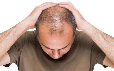 Androgenic Alopecia