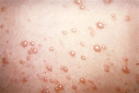 Early Stage Chicken Pox Rash Adults - mavieetlereve