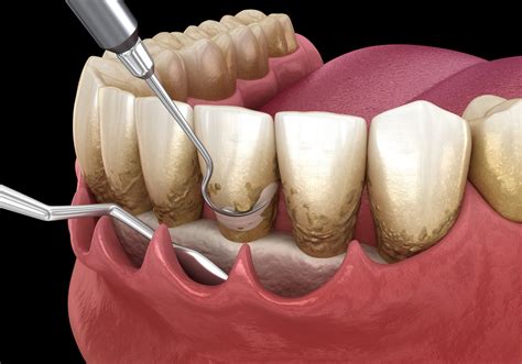 Periodontal Treatment Newtown | Dr. Patel Yardley Dental Arts