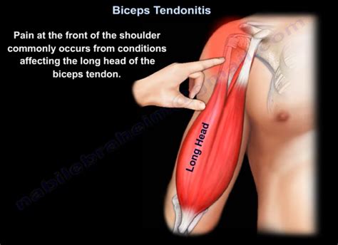 Biceps Tendonitis — OrthopaedicPrinciples.com