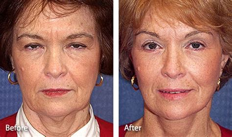 smas facelift before and after photos - smetak-faruolo-99