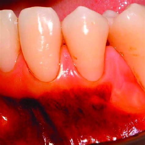 Histologic section of the area correspondent to the mucogingival... | Download Scientific Diagram