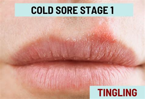 Cold Sore Stages, with Pictures