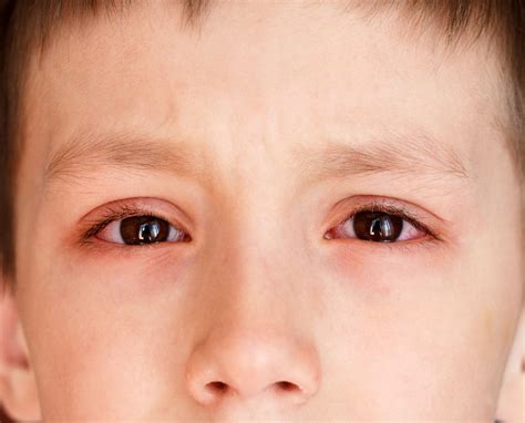 Pink Eye (Conjunctivitis): Causes, Symptoms & Treatment | Live Science