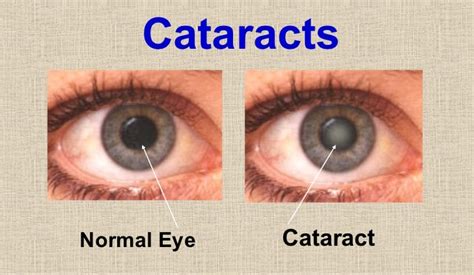 Cataract Eye Treatment - Ahalia Foundation Eye Hospital