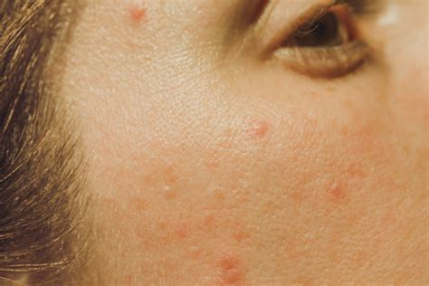 What Are the Different Types of Acne? Dermatologists Explain All