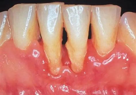 What is periodontitis? Classification and treatment | Dentistry 2024