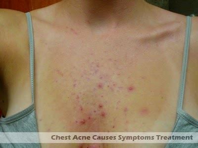 Chest Acne Causes, Symptoms and Treatment | Hormonal Acne Tips