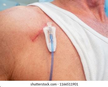 92 Chemo port 이미지, 스톡 사진 및 벡터 | Shutterstock