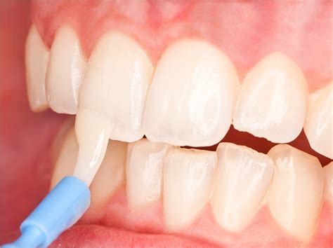 #DentalFeature: Remineralization Of Your Teeth - CNW Network