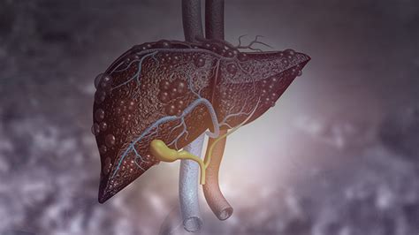 Assessing Non-Invasive Testing for Liver Fibrosis Medical Education on ReachMD