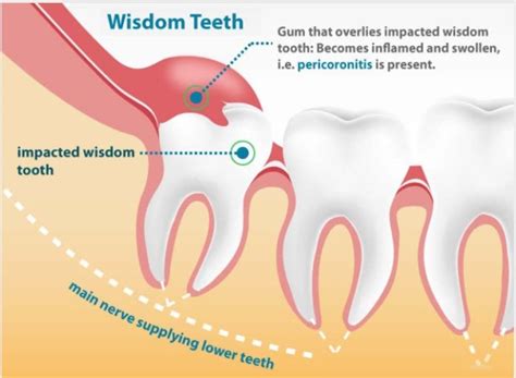 Normal Wisdom Teeth Growth