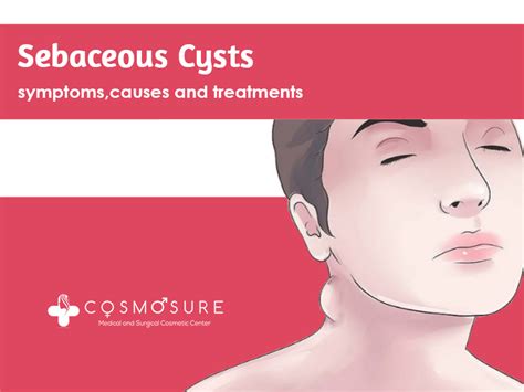 Sebaceous Cysts: Symptoms, Causes And Treatments | Cosmosure Clinic