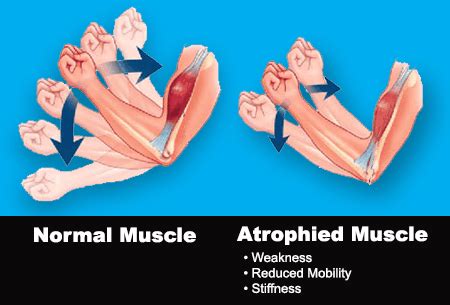 TENS & EMS Treats Muscle Atrophy - StimRx