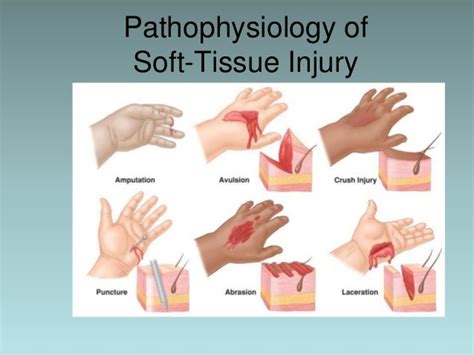 Ch05 soft tissue injury shorter