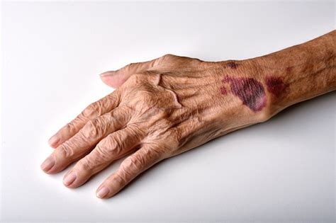 Bruise Wound On Senior People Wrist Arm Skin Falls Injury Accident In ...